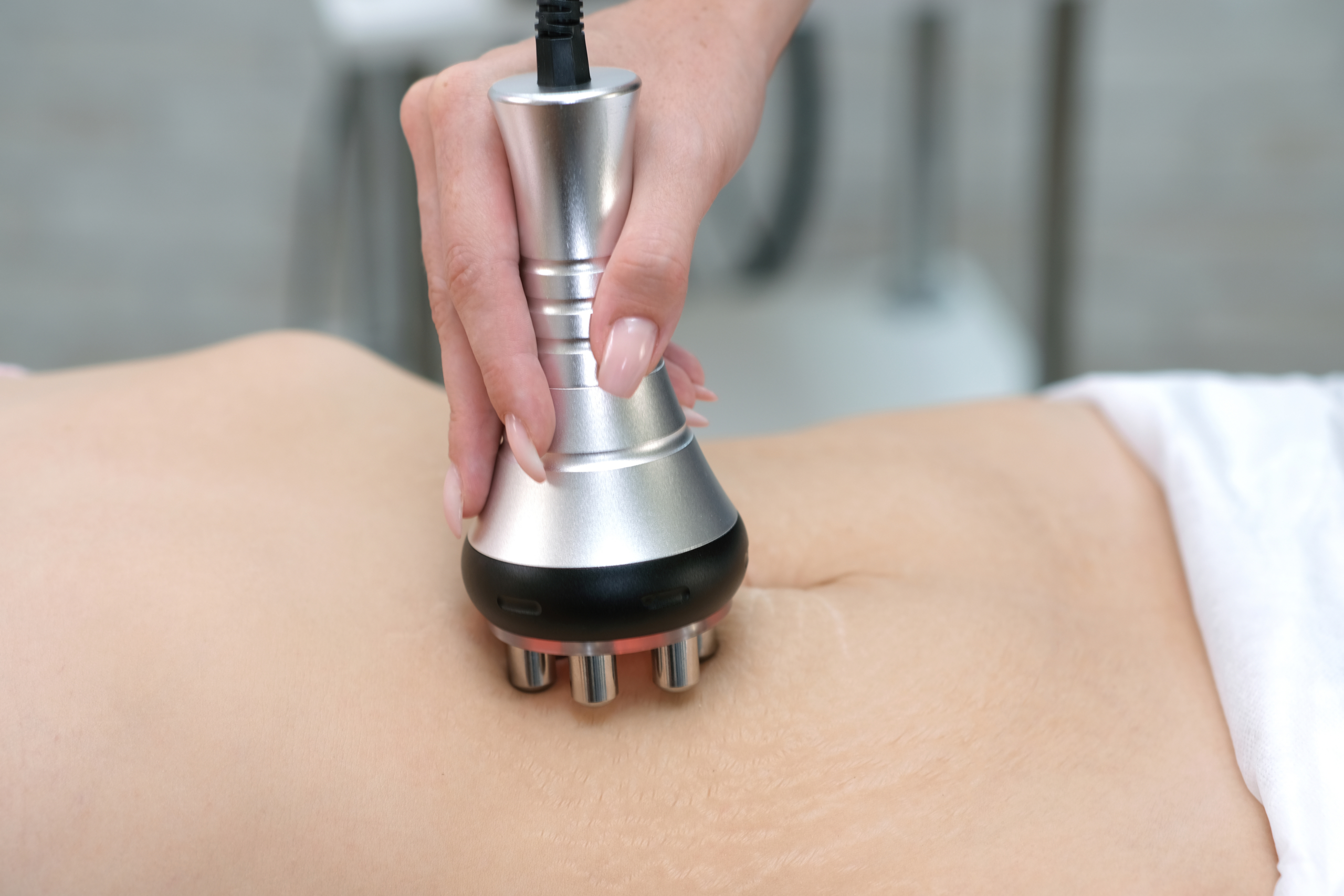 Stretch marks on the skin after childbirth and weight loss rf l at Le-Pelle med spa in Walnut Creek