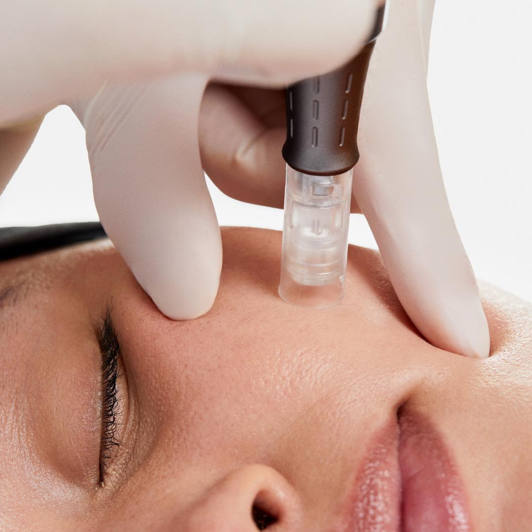 Expert Microneedling Services at LE-PELLE