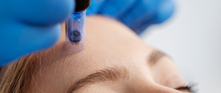 Close-up of a microneedling pen treatment on the forehead at Le-Pelle med spa in Walnut Creek